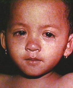 Child's face with measles rash and watery eyes