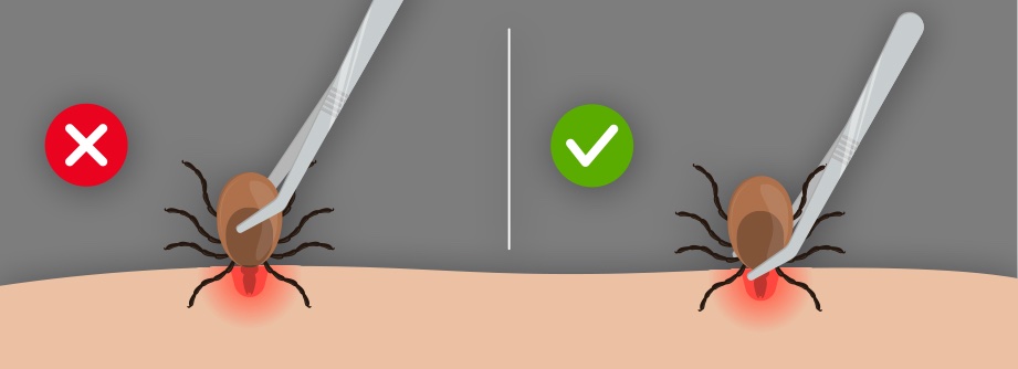 Illustration showing how to remove a tick.