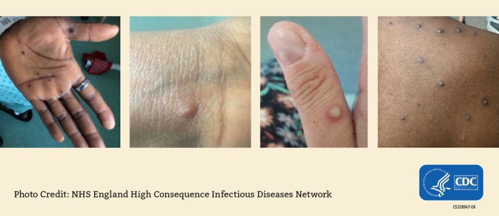 Mpox rashes