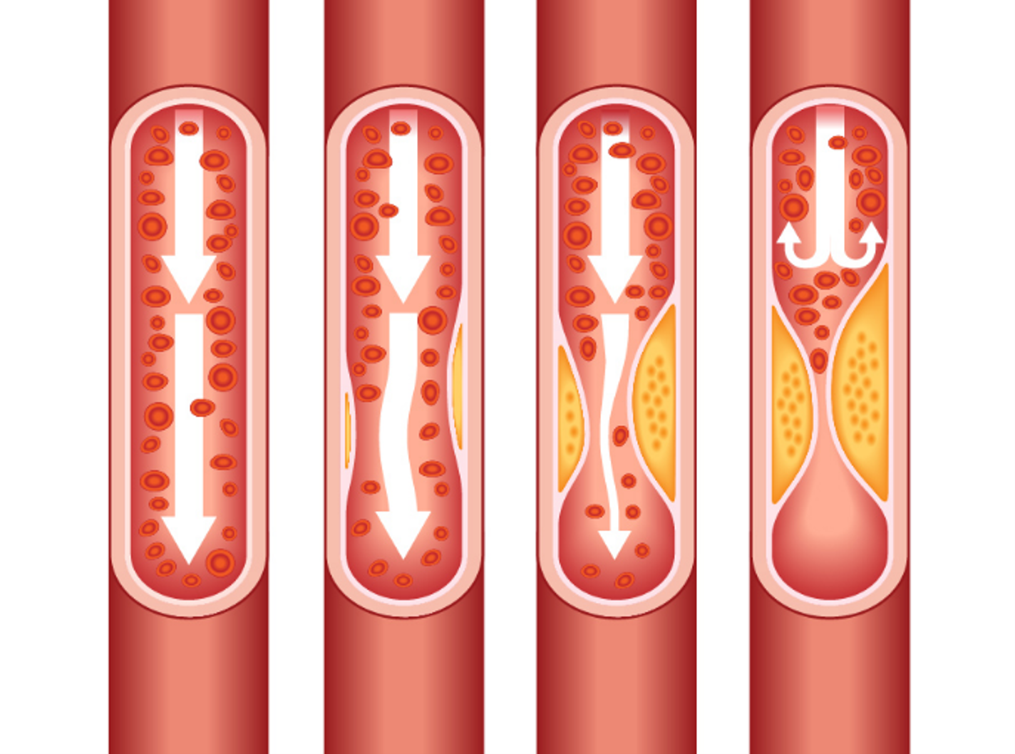 Diagram illustrating cholesterol levels